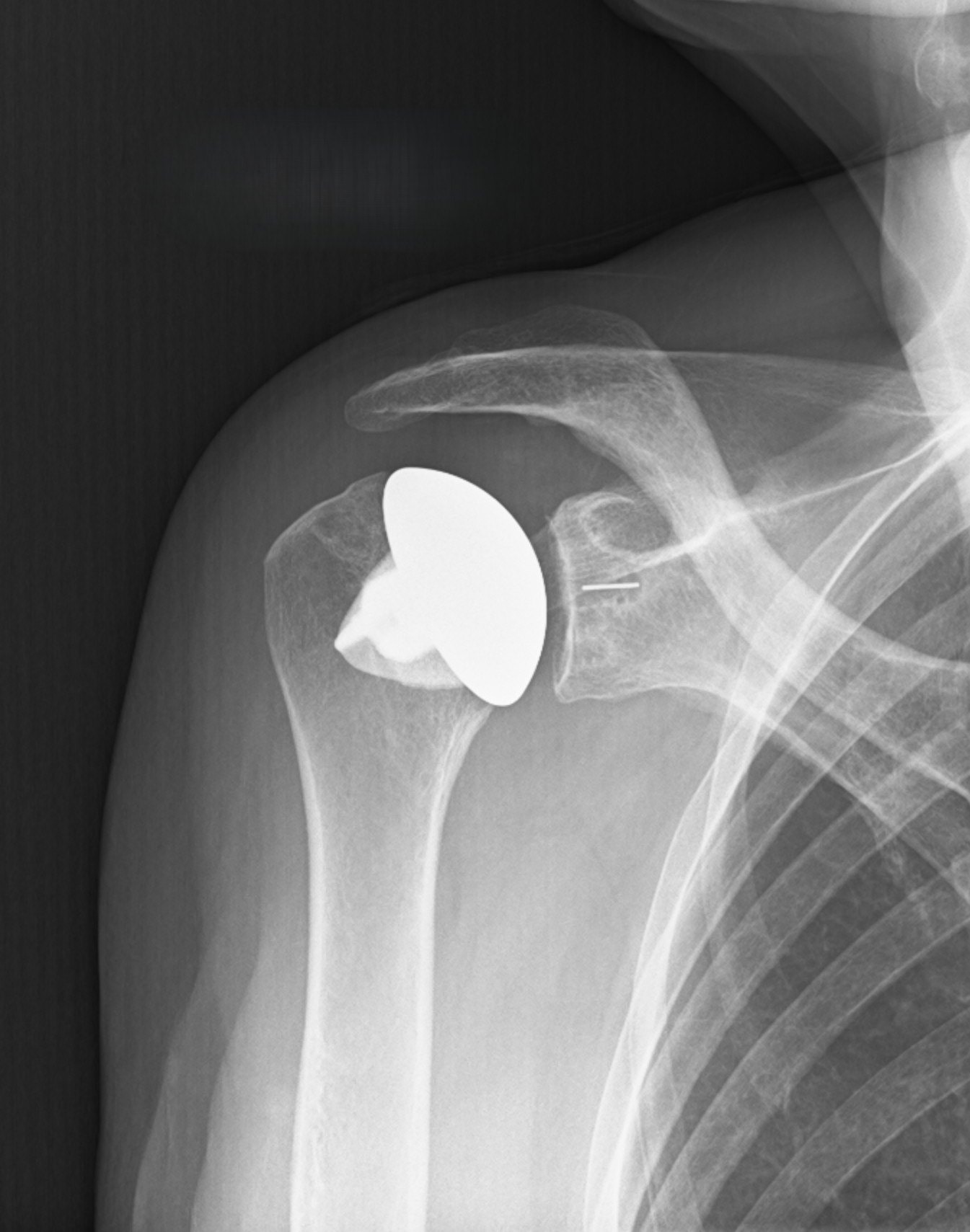 Shoulder MidHead IR